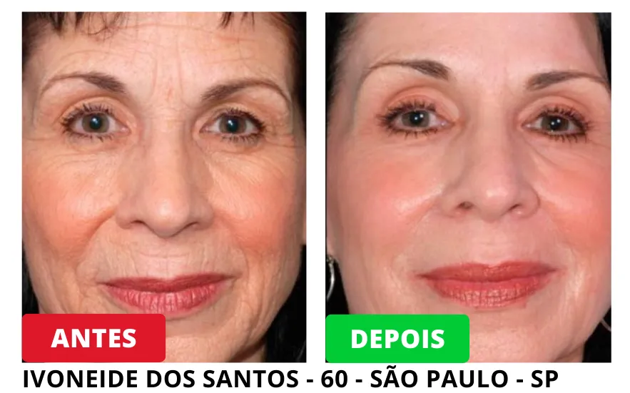 Resultados Antes e Depois