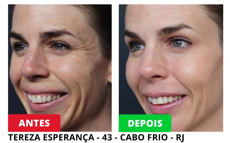 Resultados Antes e Depois