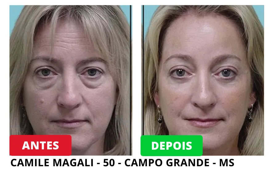 Resultados Antes e Depois