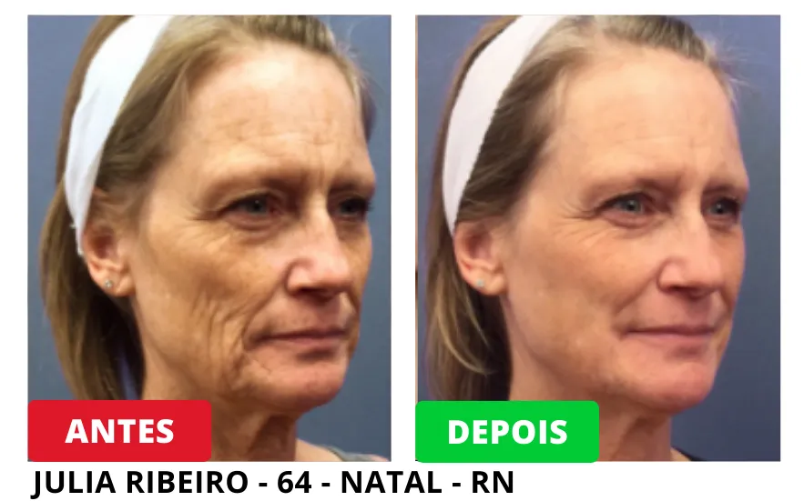 Resultados Antes e Depois