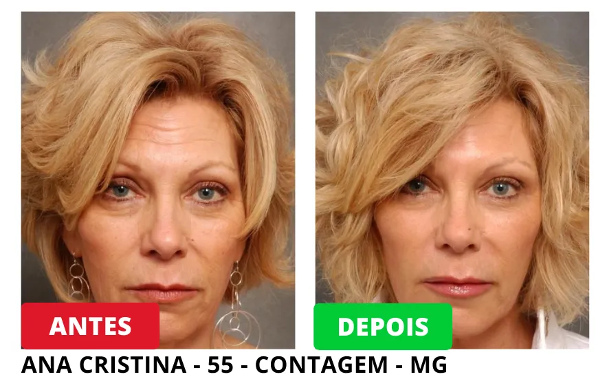 Resultados Antes e Depois