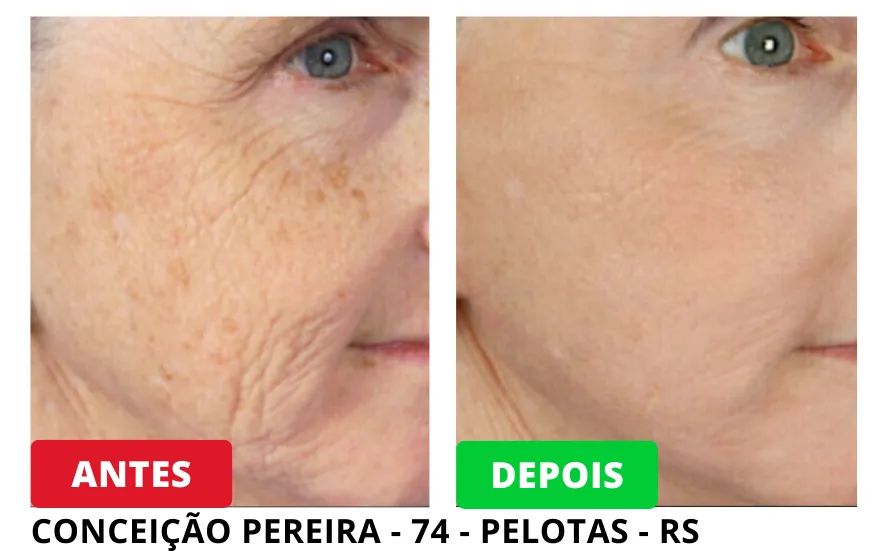 Resultados Antes e Depois